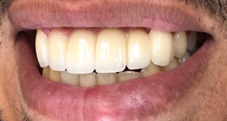 Smile with flawless replaced top teeth